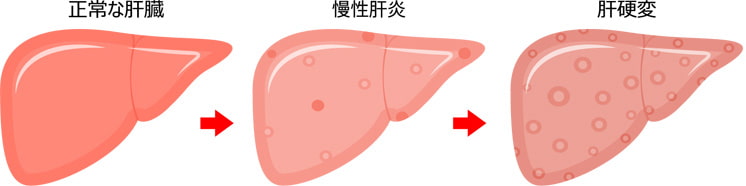 正常な肝臓と慢性肝炎と肝硬変のイラスト